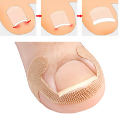 Hyggear Ingrown Toenail Set with Breathable Ingrown Toenail Patches