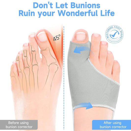 HYGGEAR Big Toe Bunion (Hallux Valgus) Corrector