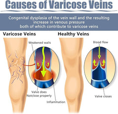Hyggear Varicose Veins Cream - Natural Relief Treatment for Legs, Spider Varicose Vein and Strengthen Capillary Health