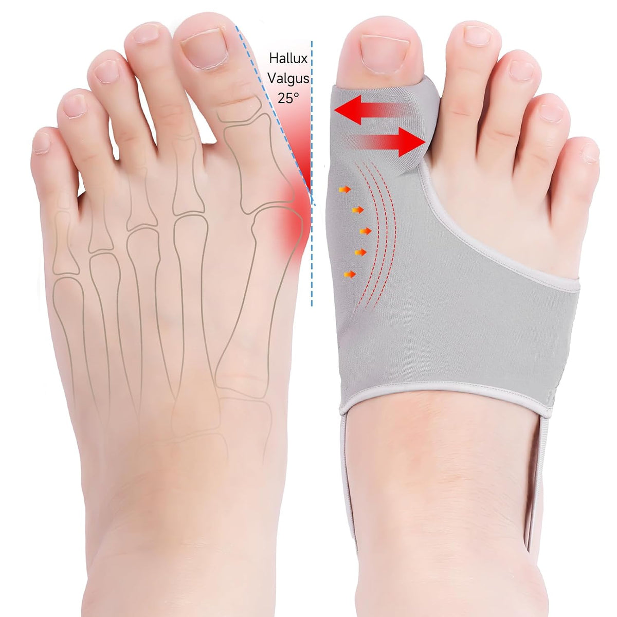 Hyggear Big Toe Bunion [Hallux Valgus] Corrector