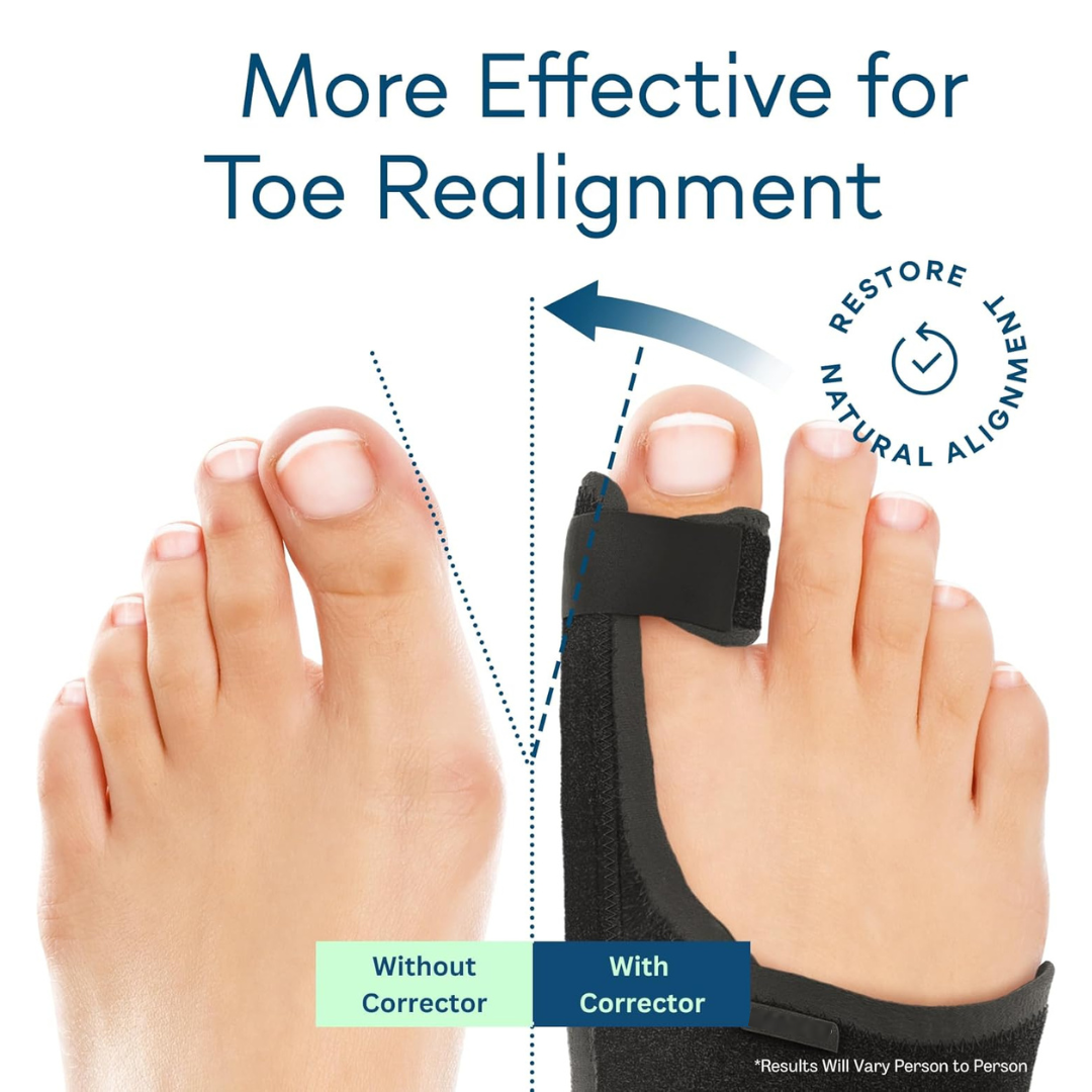 Toe Realignment Surgery Hyggear Orthopedic Bunion Splint for Hallux Valgus Pain Relief, Bunion ...
