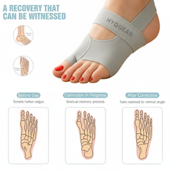 HYGGEAR Big Toe Bunion [Hallux Valgus] Corrector