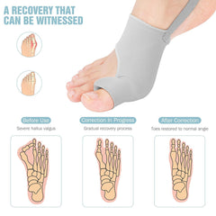 Hyggear Big Toe Bunion [Hallux Valgus] Corrector