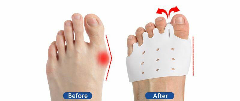 Discover How Toe Separators Transformed My Foot Pain Relief Journey ...